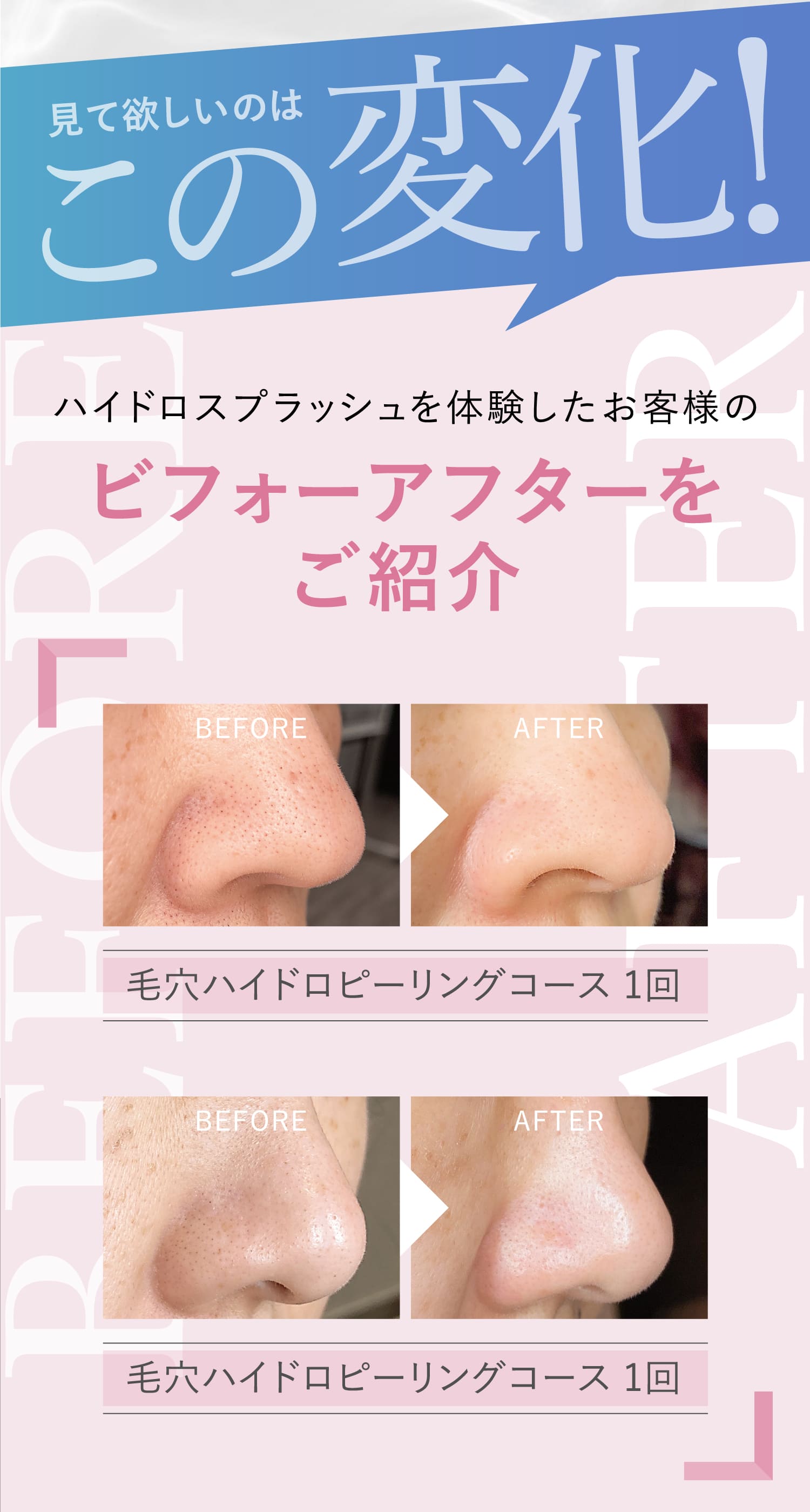 見て欲しいのはこの変化！ハイドロスプラッシュを体験したお客様のビフォーアフターをご紹介BEFORE AFTER 毛穴ハイドロピーリングコース 1回