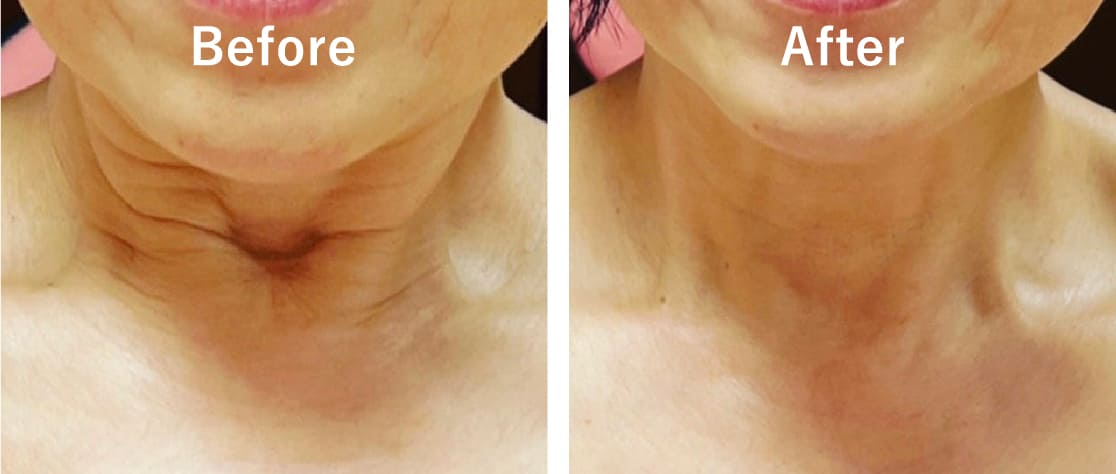 Before After