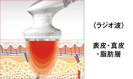 ラジオ波